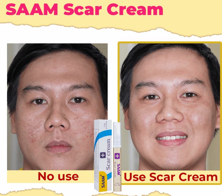 SAAM Scar Cream